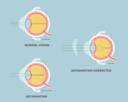 globo ocular anatomía, interno órganos cuerpo parte nervioso sistema, astigmatismo corregido, vista concepto, vector ilustración dibujos animados plano diseño acortar Arte