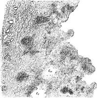 Wall of tuberculous cavity, vintage engraving. vector