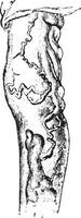 Varicose veins of the leg, vintage engraving. vector