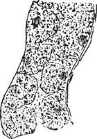 granular degeneración de el riñón epitelio, Clásico grabado. vector