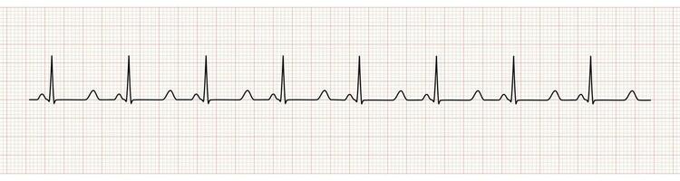 EKG Monitor Showing  Sinus Rhythm with prolong QT interval vector