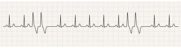 EKG Monitor Showing  Sinus Rhythm with Couplets PVC vector