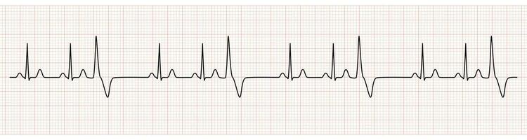 EKG Monitor Showing  Sinus Rhythm with Trigeminy PVC vector