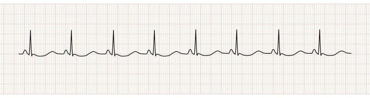 EKG Monitor Showing  Sinus Rhythm with U wave represented Hypokalemia vector