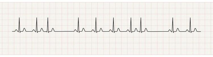 EKG Monitor Showing  Sinus Rhythm with PAC vector