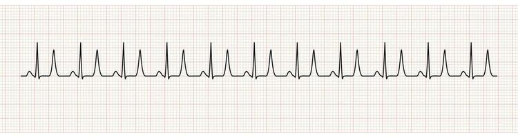 ekg monitor demostración seno ritmo con alto t ola representado hiperpotasemia vector