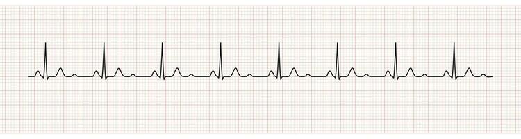 EKG Monitor Showing  Sinus Rhythm with U wave represented Hypokalemia vector