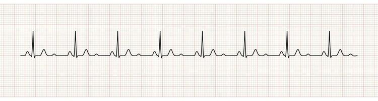 EKG Monitor Showing  Sinus Rhythm with U wave represented Hypokalemia vector