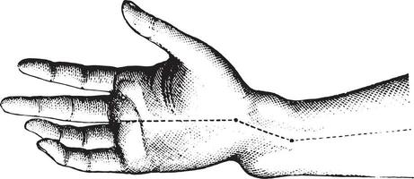 Fracture of the lower extremity of the radius. The figure shows vector