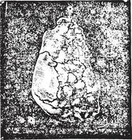 Calculation of sodium urate enchatonne in the bladder mucosa and vector