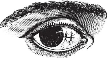 Suture of the conjunctiva after excision of pterygium, vintage e vector