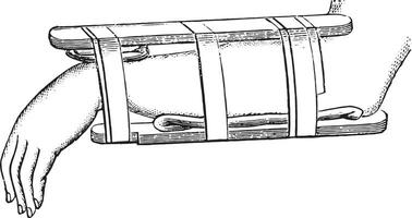 nelatón dispositivo para fracturas de el distal radio, Clásico grabado vector