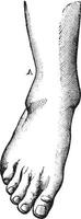 Fibula fracture with A highly charged, and a projection of the f vector