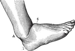 dislocación de el pie adelante, Clásico grabado. vector