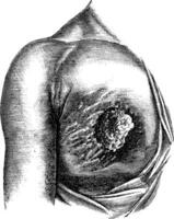 Scirrhous breast ulcer has developed its core and periphery, vin vector