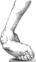 Clubfoot associated with equine varus, vintage engraving. vector