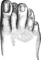 Faulty position of the second toe, vintage engraving. vector