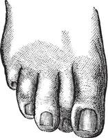 Faulty position of the second toe causing the embodiment of the nail of the second toe, vintage engraving. vector