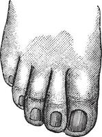 Faulty position of the big and second toe, vintage engraving. vector