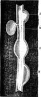 un crateriforme aneurisma. b. sacular aneurisma. C. fusiforme aneurisma. d. diseccionar aneurisma, Clásico grabado. vector