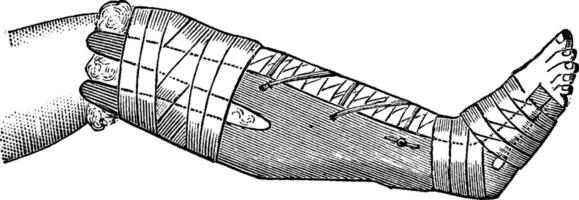 pierna envuelto con vendaje arrollado en zinc óxido o calamina, vinta vector