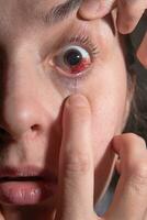 Hemorrhage in the eye of a girl. Abrasion of the cornea. Macro. photo