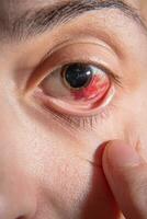 hemorragia en el ojo de un muchacha. abrasión de el córnea. macro. foto