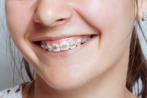 Young woman portrait with dental braces natural photo