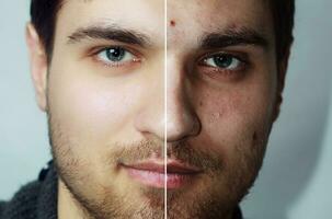 Before and after cosmetic operation. Young pretty man portrait photo