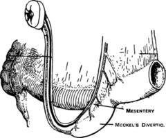 meckel divertículo, Clásico ilustración. vector