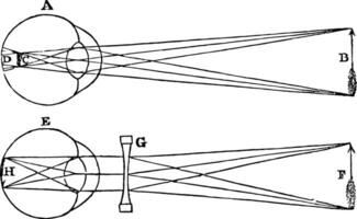 Shortsighted Vision and Correction, vintage illustration. vector