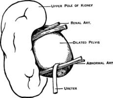 Abnormal Renal Artery, vintage illustration. vector