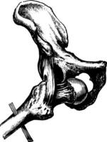 Thyroid Dislocation of the Hip, vintage illustration. vector