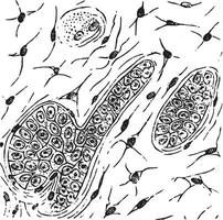 Grandular carcinoma in which the stroma has converted into mucoid tissue, vintage engraving. vector