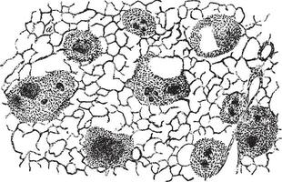 agudo diseminado tuberculosis de el pulmón, Clásico grabado. vector