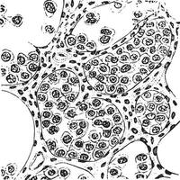 Alveolar sarcoma, vintage engraving. vector