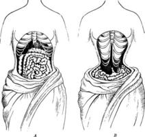 The Natural Position Compared to the Deformed Position of the Internal Organs, vintage illustration. vector