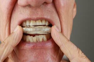 Older Mature Man putting in a night Guard in his mouth to prevent grinding photo