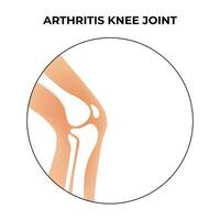 Arthritis Knee Joint Science Design Vector Illustration