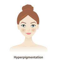 hiperpigmentación, melasmas, oscuro lugares en mujer cara vector en blanco antecedentes. piel pigmento descoloramiento, oscurecido pigmento, anormalmente alto cantidad de melanina. piel pigmento trastornos concepto.