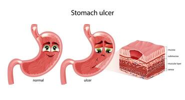 Stomach ulcers. Cute happy and sad stomach characters with faces. Stomach cross section diagram. Anatomical vector illustration