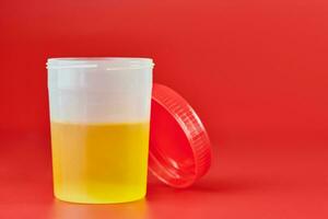 Urinalysis for urolithiasis in container photo