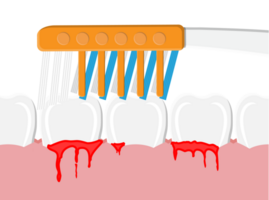 periodontal doença, sangrando gengivas png