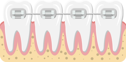 Teeth braces, orthodontics and dentistry png