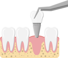 dente restauração, dental implantar png