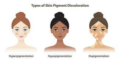 Types of skin pigment discoloration vector isolated on white background. Hyperpigmentation, darkened pigment. Hypopigmentation, lightened pigment. Depigmentation, loss of pigment.