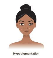 Hypopigmentation and white spots on woman face vector isolated on white background. Skin pigment discoloration, lightened pigment, a low amount of melanin in skin. Skin pigment disorders concept.