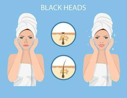 A woman wears a towel on her head with Nose pack, Blackheads on Nose. SPA beauty and health concept. Vector illustration in flat style