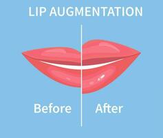 Lip Augmentation. Before and after lip filler injections. Hyaluronic Acid injections. Vector illustration in flat style