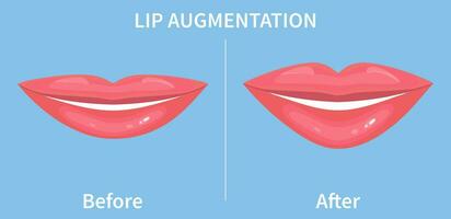 Lip Augmentation. Before and after lip filler injections. Hyaluronic Acid injections. Vector illustration in flat style